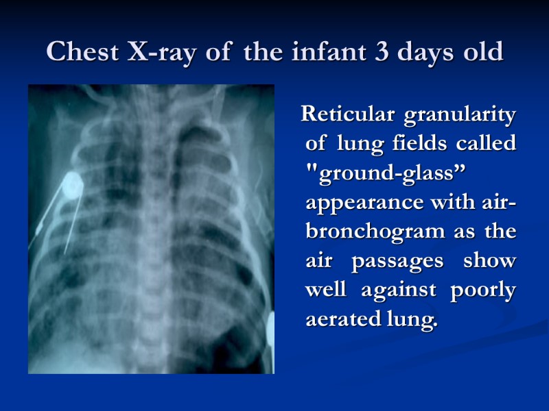 Chest X-ray of the infant 3 days old     Reticular granularity